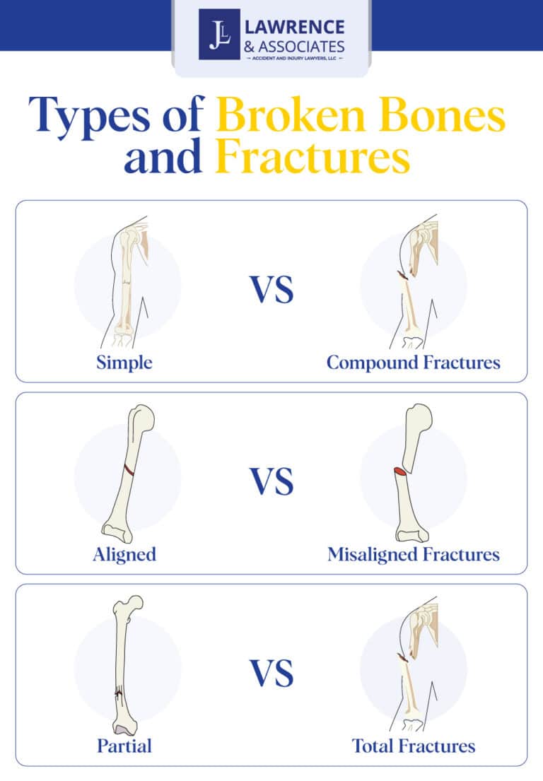 create-a-fracture: broken bones and fracture types... Broken Bone Injury Lawyer